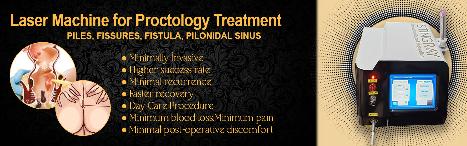 Laser Machine for Proctology Treatment